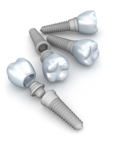Tipos de Implantes