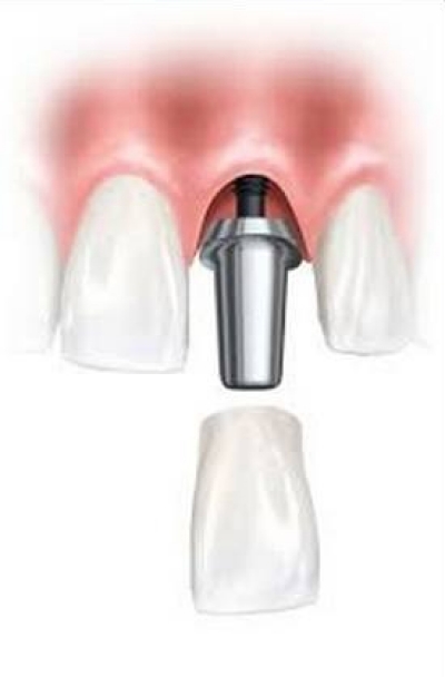 Implantes com Carga Imediata